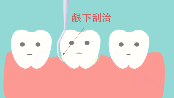 深圳牙周病治療費用多少
