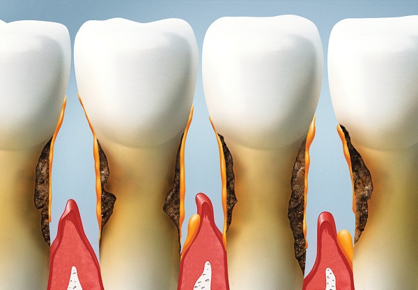 牙周炎的癥狀表現及給牙齒帶來的危害